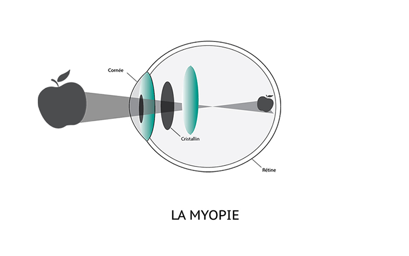 myopie